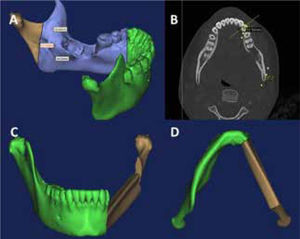 Reconstrucción tridimensional. A: Reconstrucción tridimensional de tomografía que muestra la lesión osteolítica del cuerpo mandibular izquierdo. B: vista axial de la TAC que muestra una planificación virtual de la resección. C y D planificación virtual de la reconstrucción mandibular mediante colgajo libre de fíbula izquierdo.