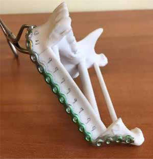 Placa de osteosíntesis contorneada sobre biomodelo 3D.