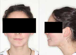 Fotografía clínica frontal y lateral de la paciente a los 5 años de la cirugía donde se aprecia la simetría facial.