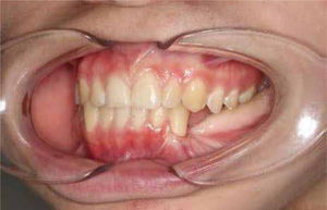 Foto intraoral donde se aprecia la reconstrucción de los tejidos blandos intraorales.