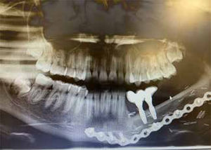 Radiografía panorámica con implantes oseointegrados instalados sobre el injerto de fíbula.
