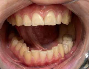 Fotografía intraoral de rehabilitación sobre implantes finalizada.