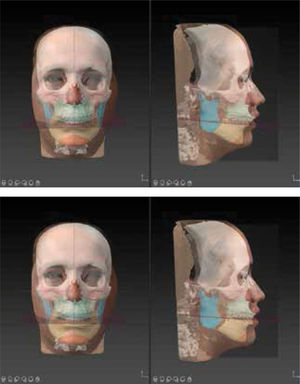 Situación inicial y planificación del tratamiento virtual 3D Observe el avance mandibular y la corrección del canteo maxilar y el centrado del mentón. Observe que también podemos incorporar una fotografía 3D a la simulación de los tejidos blandos (IPS CaseDesigner® v 2.3.5.2, KLS Martin, Tuttlingen, Alemania).