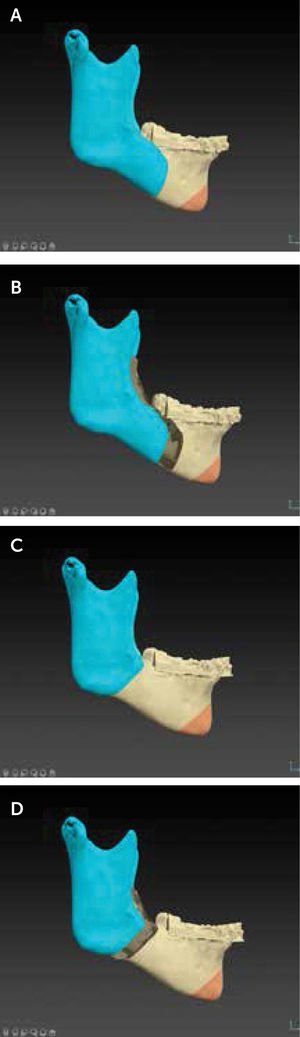 Ostetotomía sagital de rama mandibular A. Ostetotomía sagital de rama mandibular convencional. B. Osteotomía sagital de rama mandibular mínimamente invasiva. Observe las diferencias del diseño y cantidad del tejido óseo comprometido en cada una. Observe como para la misma cantidad de avance mandibular el gap óseo sería menor en la técnica mínimamente invasiva. (IPS CaseDesigner® v 2.3.5.2, KLS Martin, Tuttlingen, Alemania).