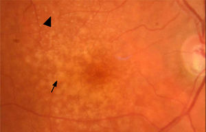Fotografía de fondo de ojo Se observa en zona macular drusas blandas conﬂuentes (ﬂecha) y depósitos drusenoides subretinianos (punta de ﬂecha). Además, se observa excavación papilar aumentada en polo inferior con disminución del reborde neuroretinal (glaucoma).