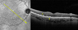 Tomografía óptica de coherencia de dominio espectral de la zona macular Se observan depósitos en el subepitelio pigmentario, drusas blandas (ﬂecha) y depósitos drusenoides subretinales (punta de ﬂecha).