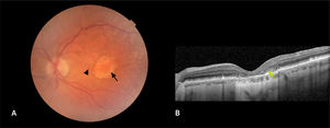 Fotografía de fondo (A) y OCT macular correspondiente (B) A. Se observa área de atrofia geográfica de la retina externa y coriocapilaris (flecha) y acúmulos pigmentarios intraretinales (punta de flecha). B. Atrofia de la retina externa (flecha).