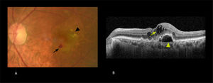 Fotografía de fondo de ojo (A) y OCT macular correspondiente (B) A. Hemorragia retinal (ﬂecha). Drusas blandas (punta de ﬂecha) B. Se observa líquido intraretinal que distorsiona arquitectura foveal (ﬂecha) y desprendimiento del epitelio pigmentario (punta de ﬂecha).
