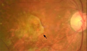 Fotografía de fondo de ojo Cicatriz macular fibrosa subretinal, con daño irreversible de la retina externa (flecha).