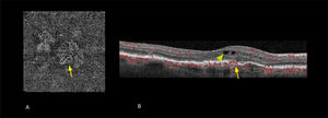 OCT-A (angiografía de retina por tomografía de coherencia óptica) en fase a nivel del epitelio pigmentario (A) y asociado a OCT estructural (B) Las imágenes muestran que la membrana neovascular coroidea ha penetrado por debajo del epitelio pigmentario (ﬂecha) y edema intraretinal (punta de ﬂecha).