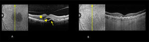 Degeneración macular asociada a la edad neovascular (DMAEn) Fotografía infrarroja y tomografía de coherencia óptica de dominio espectral (OCT). A Pre tratamiento. Agudeza visual de 0,5. Se observa acumulación de líquido en los espacios subepitelio pigmentario (flecha), subretinal (cabeza de flecha) e intrarretinal (estrella) al OCT. B. Post tratamiento con aflibercept respuesta inicial después de 3 inyecciones mensuales. Agudeza visual 1,0 parcial. Se observa reabsorción casi total del líquido en los espacios subepitelio pigmentario, subretinal e intrarretinal.