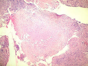 Biopsia de endometrio. Se constata presencia de proceso inflamatorio crónico, granulomatoso, células gigantes de tipo Langhans y necrosis caseificante (H&E ×100).