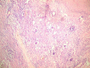 Biopsia de la goma tuberculosa enbursa trocantérica derecha. El corte histológico muestra la presencia de necrosis caseosa rodeada de proceso inflamatorio granulomatoso, con células gigantes de tipo Langhans (H&E ×400).