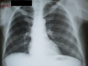 Radiografía de tórax anteroposterior No se observa una imagen sugerente de tuberculosis pulmonar.