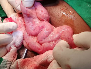 Tuberculosis intestinal Presencia, en asas intestinales, de pequeños nódulos blanquecinos típicos, descritos clásicamente como similares a semillas de mijo.