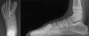 Radiografía inicial, se evidencia polisindactilia con coalición del 1er y 2°metatarsiano derecho.