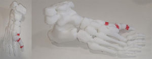 Modelo 3D para planificación preoperatoria.