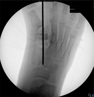 Visión fluoroscópica intraoperatoria.