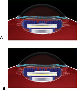 Lente intraocular acomodativo A. Lente intraocular acomodativo Juvene® IOL (LensGen®) con músculo ciliar relajado. B. Lente intraocular acomodativo Juvene® IOL (LensGen®) con músculo ciliar contraído.