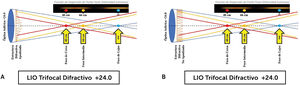 Lentes intraoculares trifocales apodizados y no apodizados A. Lente intraocular trifocal difractivo apodizado como FineVision® (BVI-PhysIOL). B. Lente intraocular trifocal difractivo no apodizado PanOptix® (Alcon) o AT LISA tri® (Zeiss).