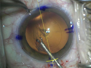 Capsulorexis circular continua con micropinza MST.