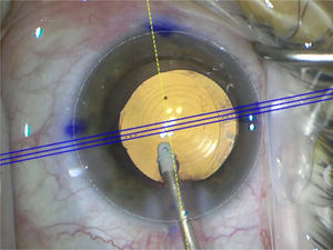Alineación del LIO tórico con marcación digital (CALLISTO eye, Zeiss).