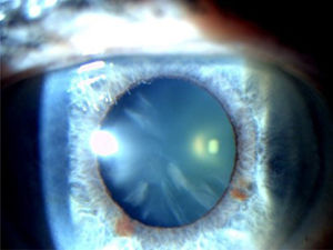 Catarata cortical.