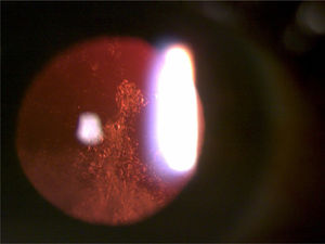 Retroiluminación de una catarata subcapsular posterior.