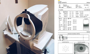 Equipo IOL Master 700 y su Reporte Biométrico.