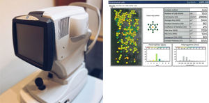 Microscopio Especular NIDEK y su Reporte de Células Endoteliales.