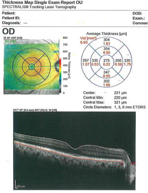 Reporte de OCT macular Spectralis®.
