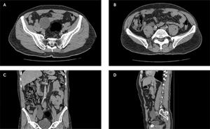 Ventana abdominal de la TAC abdomino-pélvico con inyección de medio de contraste en cortes axiales (A y B): masa quística de pared delgada (estrella) a nivel del apéndice distal (flecha blanca). Ventana abdominal de la TAC abdómino-pélvico con inyección de medio de contraste en cortes coronal (C) y sagital (D): masa quística de pared delgada (estrella) a nivel del apéndice distal (flecha blanca).