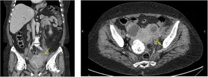 Tomografía computada de abdomen y pelvis. Corte coronal (a) y corte axial (b). Aumento de volumen masiforme del útero con extensión al anexo izquierdo con múltiples imágenes quísticas con paredes engrosadas, algunas sugerentes de abscedación, con aumento de densidad del tejido adiposo de aspecto inflamatorio infeccioso. Al interior de masa se observa DIU.