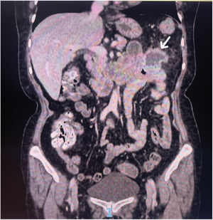 La tomografía computarizada de abdomen y pelvis con contraste que evidencia una fístula entre intestino delgado y colon transverso distal.