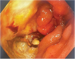 En la imagen colonoscópica se observa una mucosa indurada con fibrina en intestino delgado que se visualiza con colonoscopio desde orificio fistuloso del colon transverso.