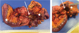 Pieza operatoria de yeyuno (estrella) y colon transverso (círculo) con zona indurada y trayecto fistuloso (flecha) que conecta ambas asas intestinales.