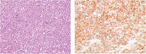 Pieza operatoria de yeyuno (estrella) y colon transverso (círculo) con zona indurada y trayecto fistuloso (flecha) que conecta ambas asas intestinales. Hematoxilina y eosina (izquierda) (60X). Inmunohistoquímica con marcador CD20 (+) (derecha) (100X).