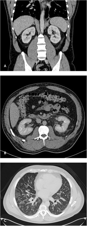 Cambios inflamatorios perirrenales. Cambios inflamatorios perirrenales evidenciados a la tomografía computada de abdomen y pelvis de ingreso (A/B), e imágenes de vidrio esmerilado a nivel pulmonar informadas como posible etiología inflamatoria infecciosa (C).