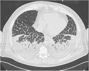 Congestión pulmonar y derrame pleural bilateral evidenciado por tomografía computada de tórax al cuarto día de evolución.