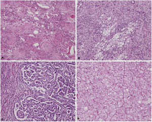 A. End stage disease caused by chronic pyelonephritis, B. Xanthogranulomatous pyelonephritis, C. Papillary renal cell carcinoma, D. Chromophobe renal cell carcinoma (H&E, X100).