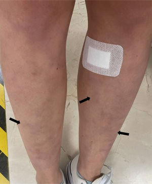 Máculas violáceas tenues (flechas) en cara anterior de extremidades inferiores al momento de la consulta inicial.