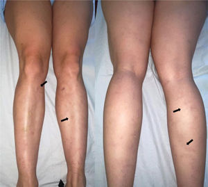 Máculas pigmentadas mal delimitadas (flechas) en cara anterior y posterior de ambas extremidades inferiores.