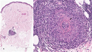 A. HE, 2x: A pequeño aumento se observa un fragmento cutáneo en el que destaca la presencia en dermis profunda de un vaso sanguíneo con infiltración linfocitaria (estrella). B. HE, 20x: A mayor aumento se trata de un vaso arterial de mediano calibre. El infiltrado permea de forma marcada la pared y se observa depósito de material fibrinoide de forma concéntrica (flecha) a la luz del mismo.