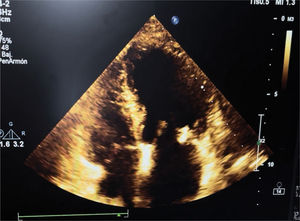 Ecocardiograma transtorácico al ingreso, en la ventana apical de 4 cámaras.