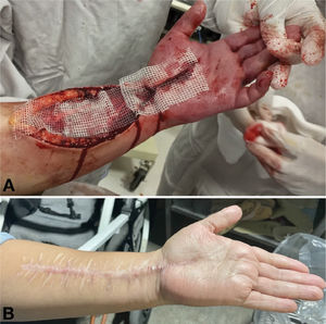 Extremidad superios derecha con datos de trombosis venosa y síndrome compartimental A. Realización de fasciotomías. B. Cicatríz de fasciotomías en fase de rehabilitación física.