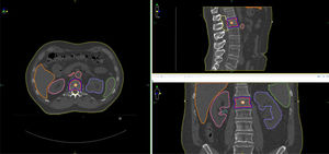 Metástasis ósea de riesgo Metástasis óseas en vertebra L1.