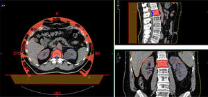 Distribución de dosis de radioterapia en metástasis Distribución de dosis de una radiocirugía de una metástasis espinal.