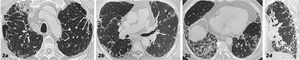 Enfermedad pulmonar intersticial fibrótica con patrón UIP Distorsión de la arquitectura pulmonar bilateral caracterizado por reticulaciones y bronquiectasias por tracción de distribución asimétrica, de predominio subpleural, Se identifican áreas de panalización y gradiente ápico-basal (reconstrucción sagital 2d).