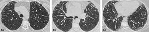 Enfermedad pulmonar intersticial fibrótica con patrón de probable UIP Distorsión de la arquitectura pulmonar, opacidades reticulares y bronquictasias por tracción de predominio basal y subpleural. No se observa panalización.