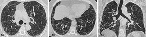 Enfermedad pulmonar intersticial fibrótica con patrón indeterminado para UIP Se observa distorsión de la arquitectura pulmonar asociado a opacidades reticulares, bronquiectasias/bronquiolectasias por tracción de predominio subpleural. No se observa gradiente ápico basal ni panalización.
